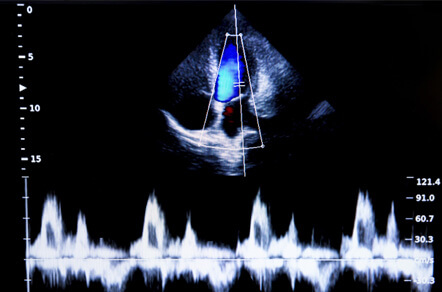 超音波(エコー)検査