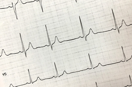 運動負荷心電図